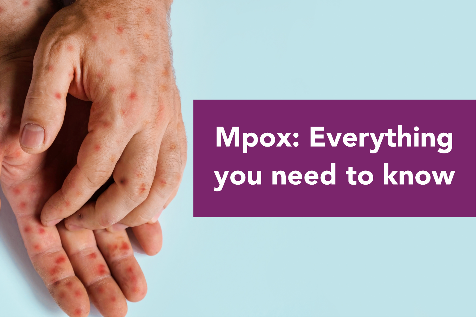 MPox: Everything you need to know